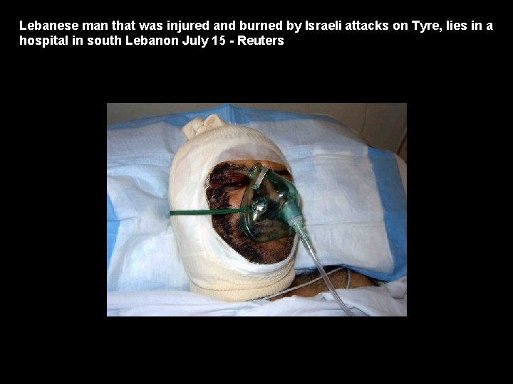 Lebanese man that was injured and burned by Israeli attacks on Tyre, lies in