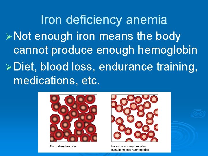 Iron deficiency anemia Ø Not enough iron means the body cannot produce enough hemoglobin