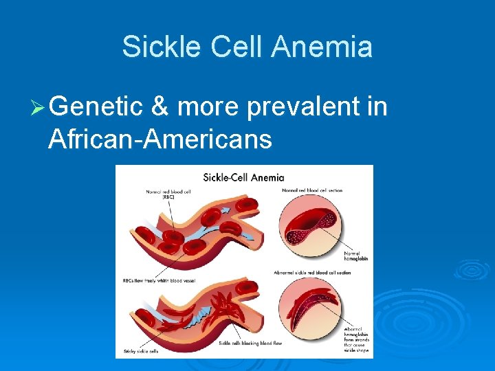 Sickle Cell Anemia Ø Genetic & more prevalent in African-Americans 