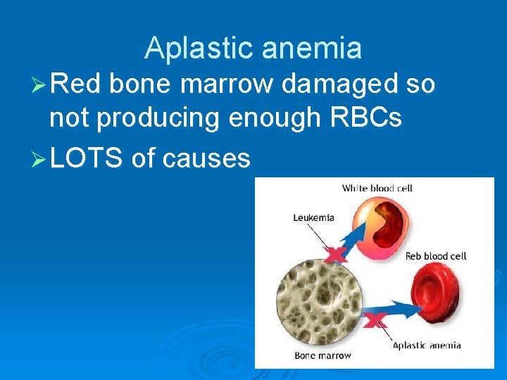 Aplastic anemia Ø Red bone marrow damaged so not producing enough RBCs Ø LOTS