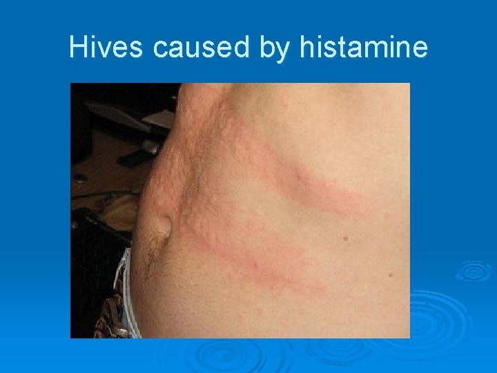 Hives caused by histamine 
