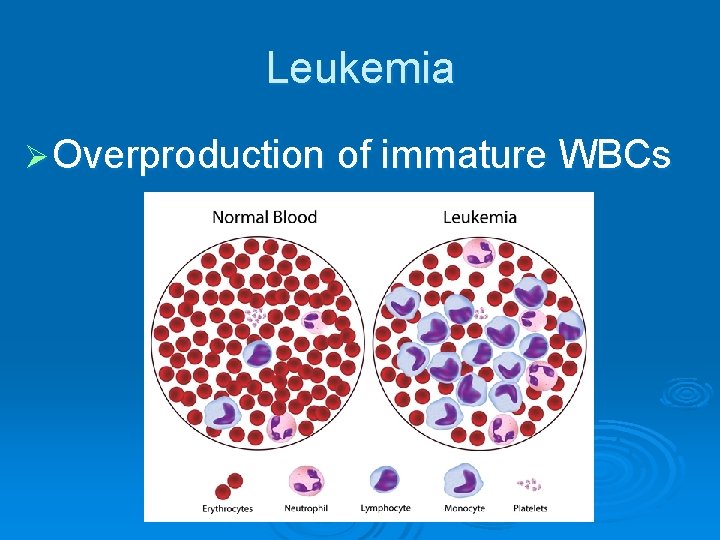 Leukemia Ø Overproduction of immature WBCs 