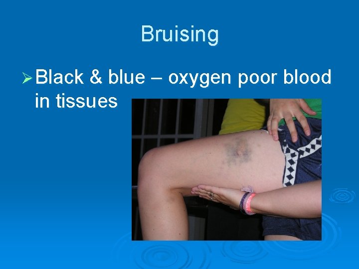 Bruising Ø Black & blue – oxygen poor blood in tissues 