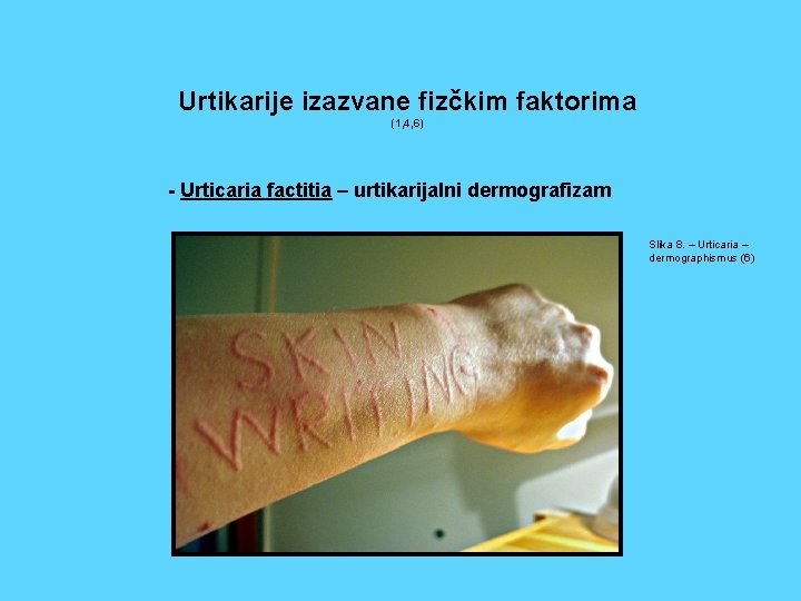 Urtikarije izazvane fizčkim faktorima (1, 4, 6) - Urticaria factitia – urtikarijalni dermografizam Slika