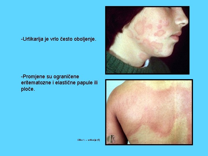 -Urtikarija je vrlo često oboljenje. -Promjene su ograničene eritematozne i elastične papule ili ploče.