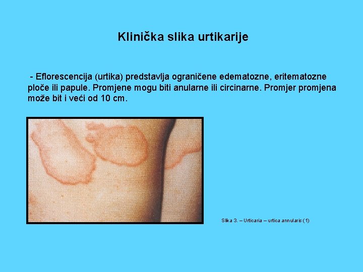 Klinička slika urtikarije - Eflorescencija (urtika) predstavlja ograničene edematozne, eritematozne ploče ili papule. Promjene