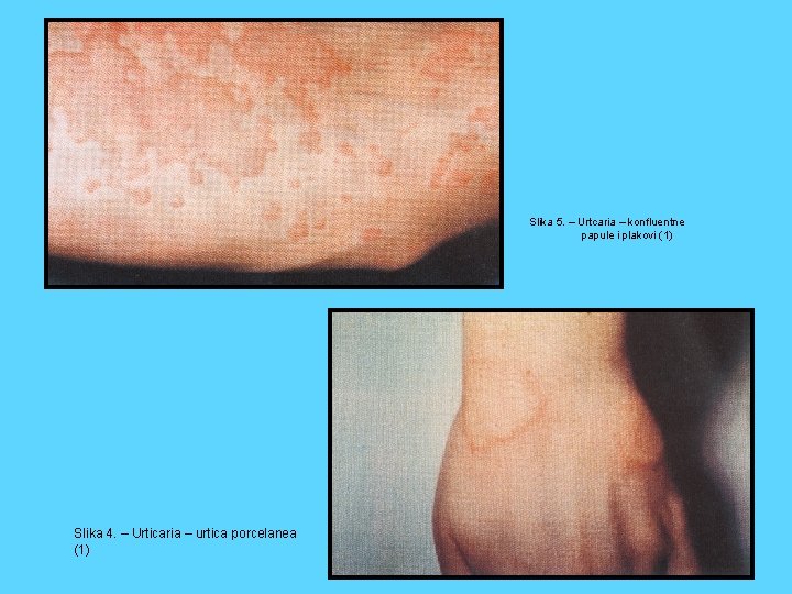 Slika 5. – Urtcaria – konfluentne papule i plakovi (1) Slika 4. – Urticaria