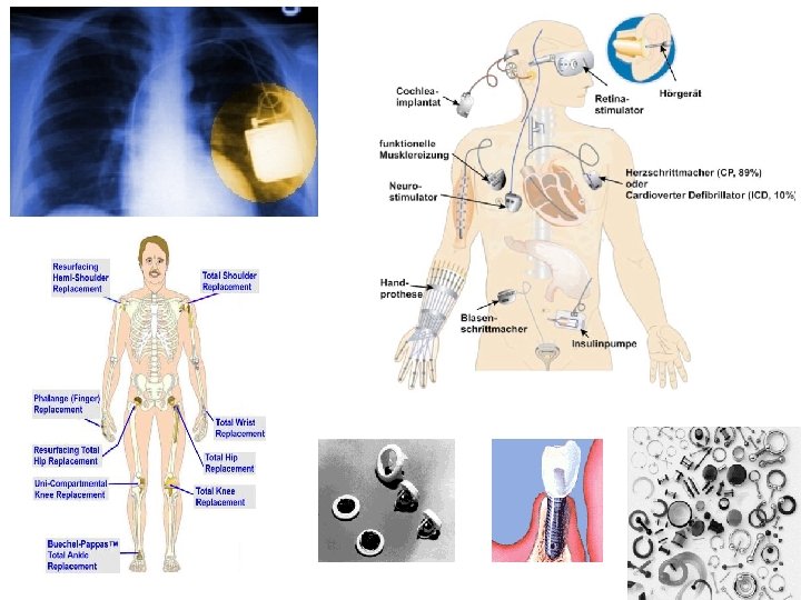 STATISCH MAGNETISCH VELD PASIEVE IMPLANTEN Yves De Deene 