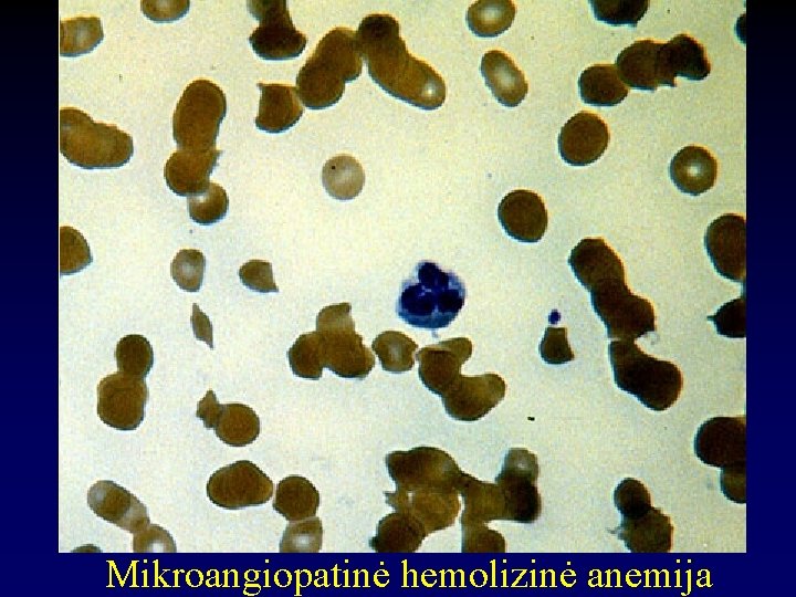 Mikroangiopatinė hemolizinė anemija 