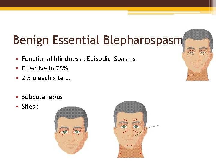 Benign Essential Blepharospasm • Functional blindness : Episodic Spasms • Effective in 75% •