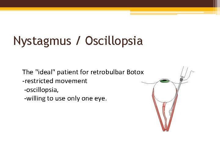 Nystagmus / Oscillopsia The "ideal" patient for retrobulbar Botox -restricted movement -oscillopsia, -willing to