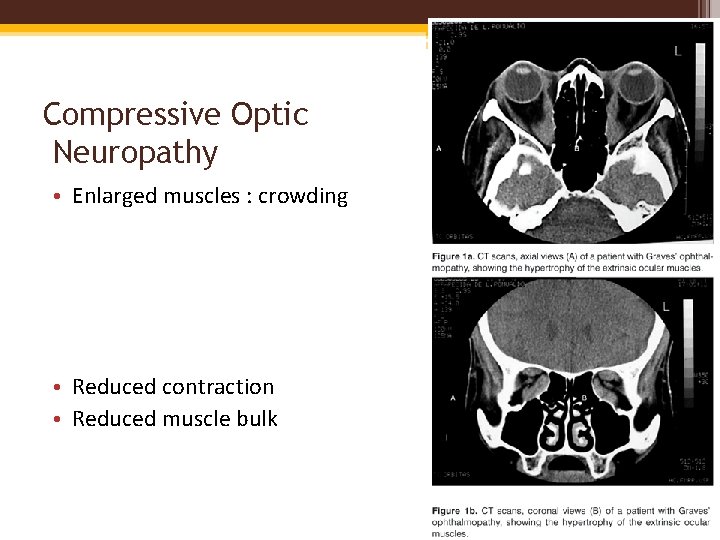 Compressive Optic Neuropathy • Enlarged muscles : crowding • Reduced contraction • Reduced muscle