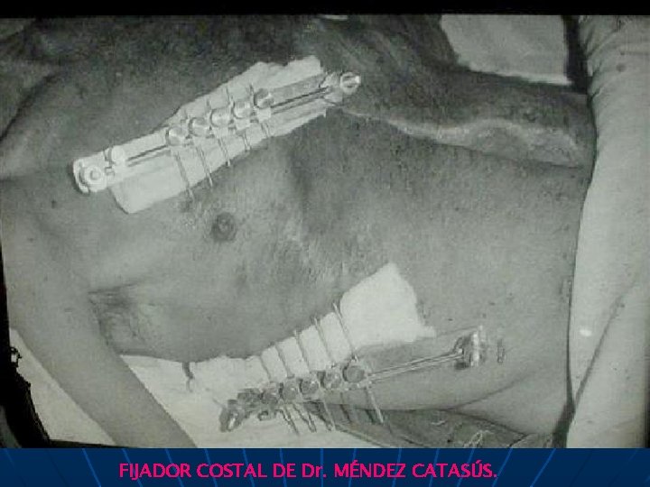 FIJADOR COSTAL DE Dr. MÉNDEZ CATASÚS. 