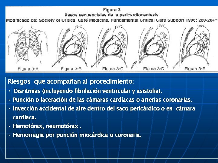 Riesgos que acompañan al procedimiento: • Disritmias (incluyendo fibrilación ventricular y asistolia). • Punción