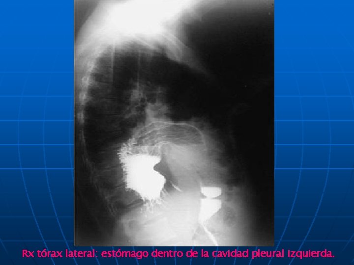 Rx tórax lateral: estómago dentro de la cavidad pleural izquierda. 