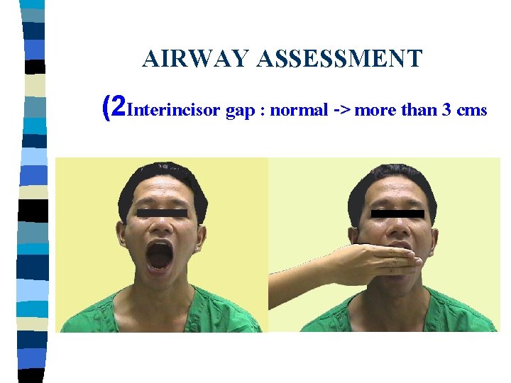 AIRWAY ASSESSMENT (2 Interincisor gap : normal -> more than 3 cms 