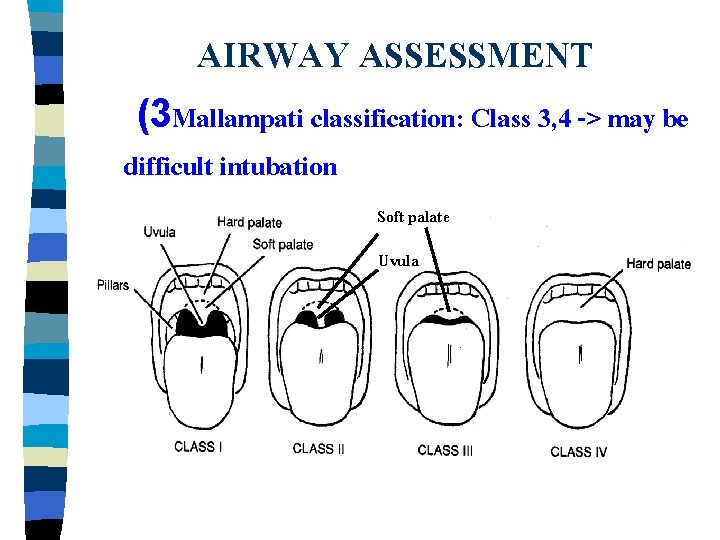 AIRWAY ASSESSMENT (3 Mallampati classification: Class 3, 4 -> may be difficult intubation Soft
