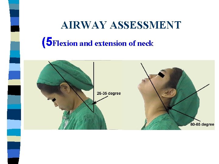 AIRWAY ASSESSMENT (5 Flexion and extension of neck 