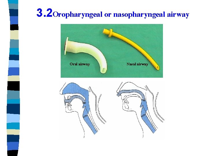 3. 2 Oropharyngeal or nasopharyngeal airway Oral airway Nasal airway 
