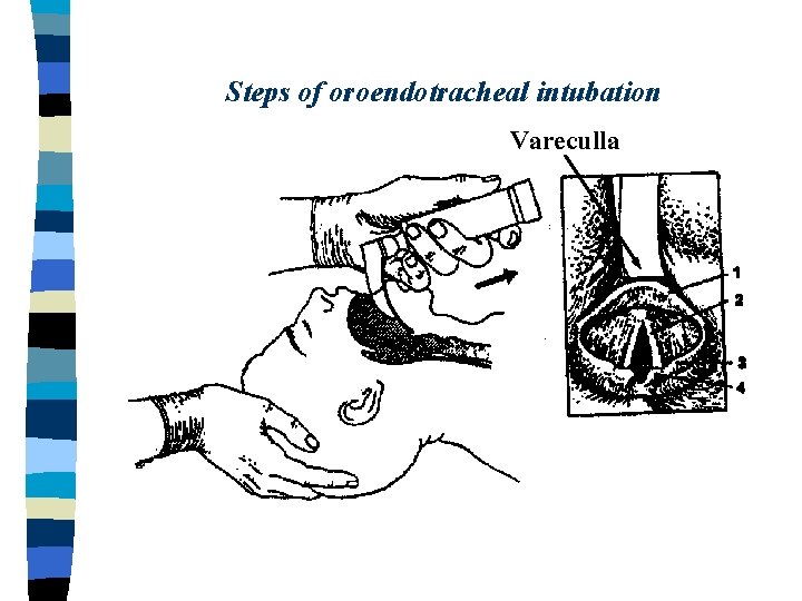 Steps of oroendotracheal intubation Vareculla 