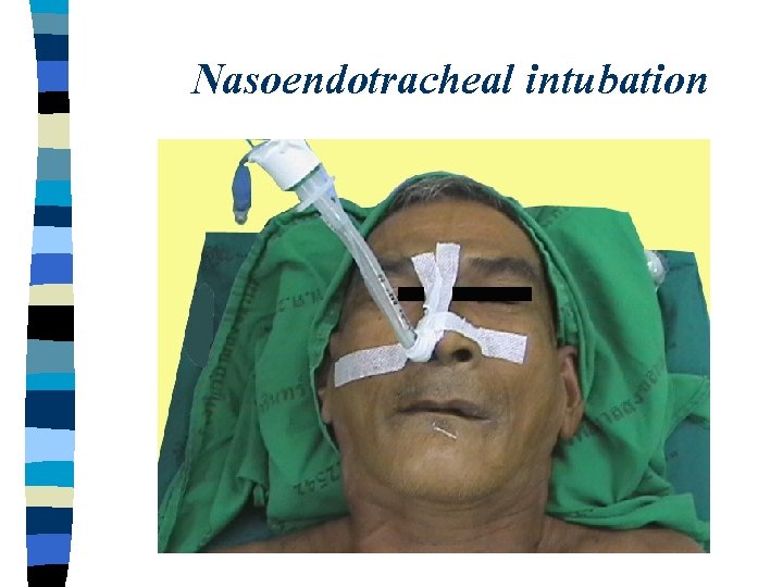 Nasoendotracheal intubation 