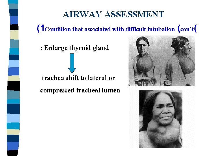 AIRWAY ASSESSMENT (1 Condition that associated with difficult intubation (con’t( : Enlarge thyroid gland