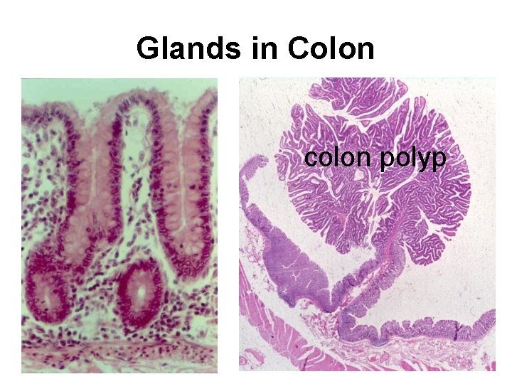 Glands in Colon colon polyp 