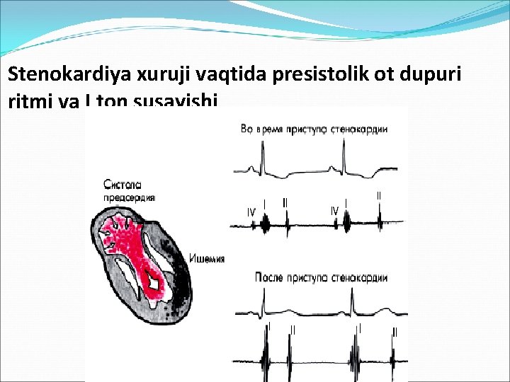 Stenokardiya xuruji vaqtida presistolik ot dupuri ritmi va I ton susayishi 