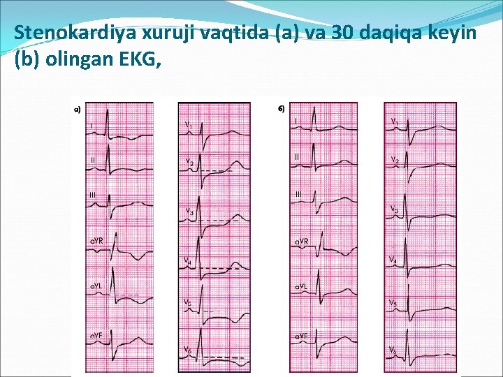 Stenokardiya xuruji vaqtida (a) va 30 daqiqa keyin (b) olingan EKG, 