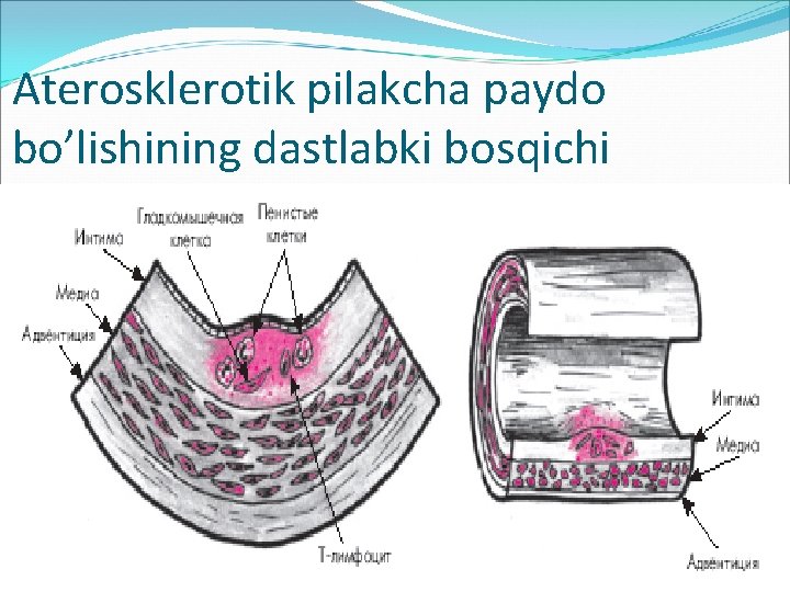 Aterosklerotik pilakcha paydo bo’lishining dastlabki bosqichi 