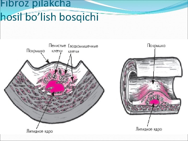 Fibroz pilakcha hosil bo’lish bosqichi 