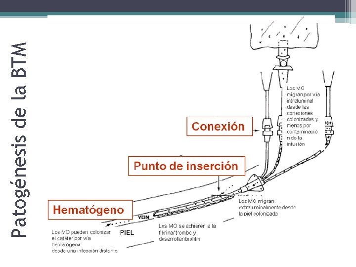 Patogénesis de la BTM 