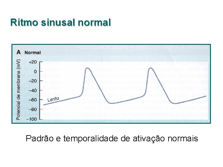Ritmo sinusal normal Padrão e temporalidade de ativação normais 