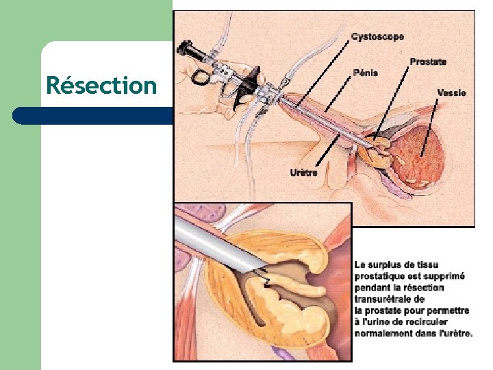 Résection 