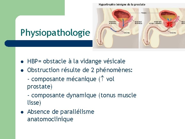 Physiopathologie l l l HBP= obstacle à la vidange vésicale Obstruction résulte de 2