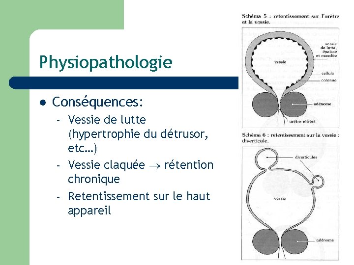 Physiopathologie l Conséquences: – – – Vessie de lutte (hypertrophie du détrusor, etc…) Vessie