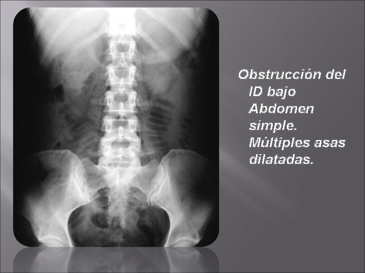 Obstrucción del ID bajo Abdomen simple. Múltiples asas dilatadas. 