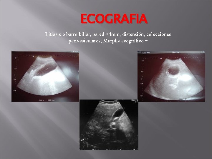 ECOGRAFIA Litiasis o barro biliar, pared >4 mm, distensión, colecciones perivesiculares, Murphy ecográfico +