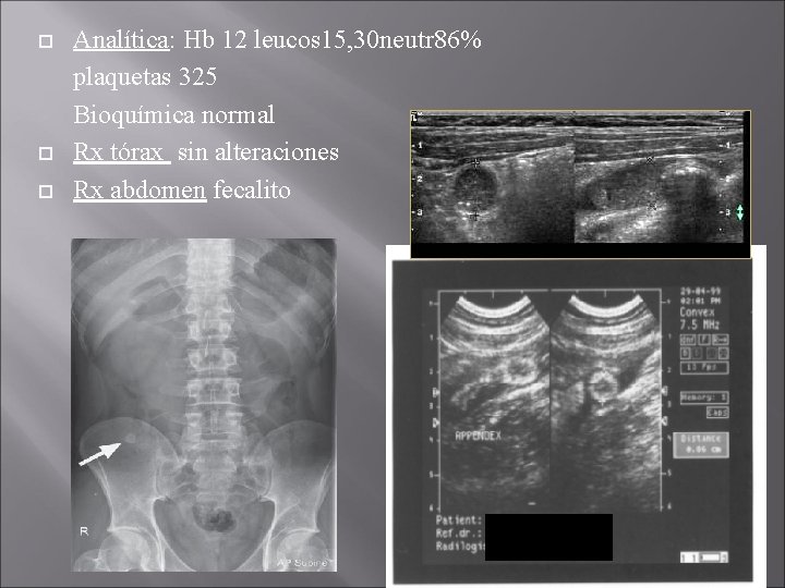  Analítica: Hb 12 leucos 15, 30 neutr 86% plaquetas 325 Bioquímica normal Rx