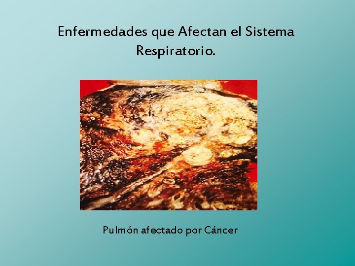 Enfermedades que Afectan el Sistema Respiratorio. Pulmón afectado por Cáncer 