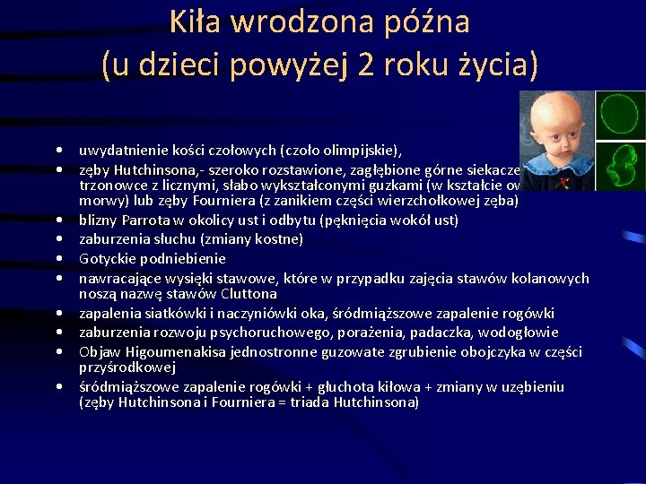 Kiła wrodzona późna (u dzieci powyżej 2 roku życia) • uwydatnienie kości czołowych (czoło