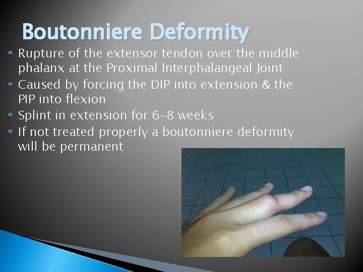 Boutonniere Deformity Rupture of the extensor tendon over the middle phalanx at the Proximal