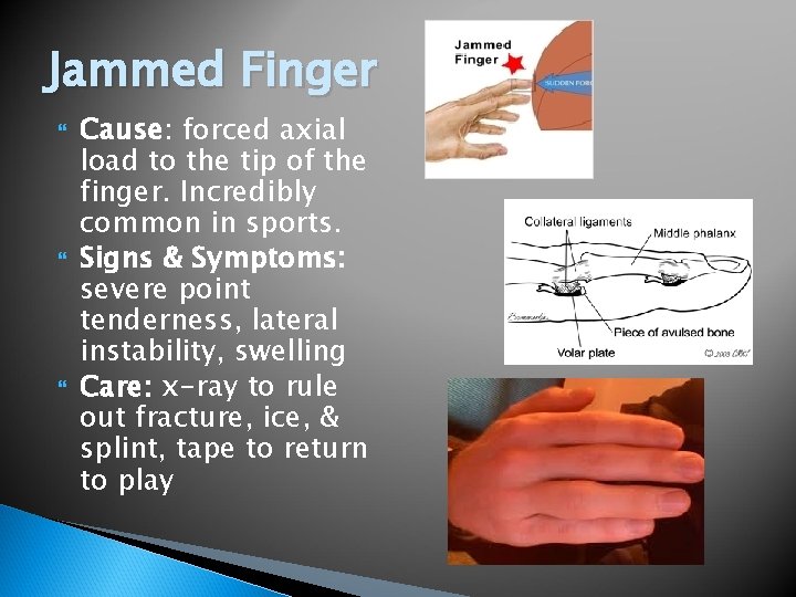 Jammed Finger Cause: forced axial load to the tip of the finger. Incredibly common