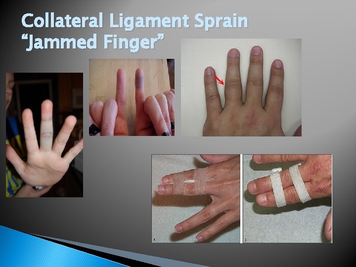 Collateral Ligament Sprain “Jammed Finger” 
