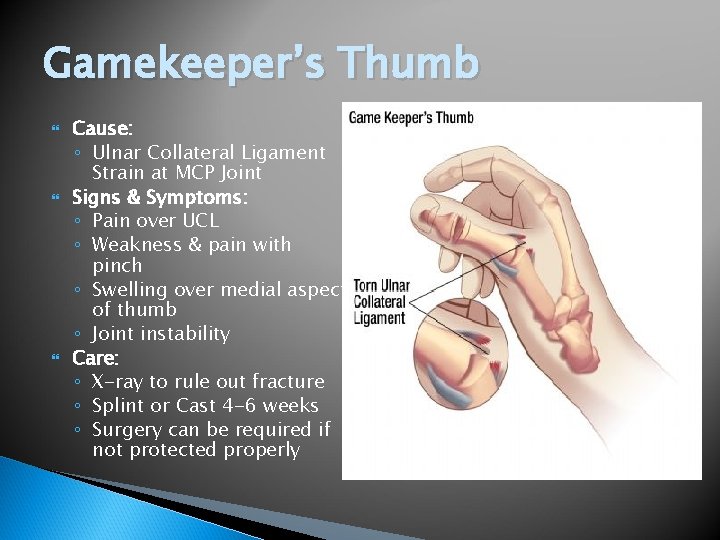 Gamekeeper’s Thumb Cause: ◦ Ulnar Collateral Ligament Strain at MCP Joint Signs & Symptoms: