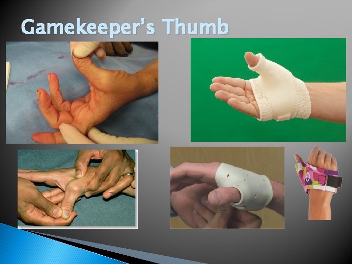 Gamekeeper’s Thumb 