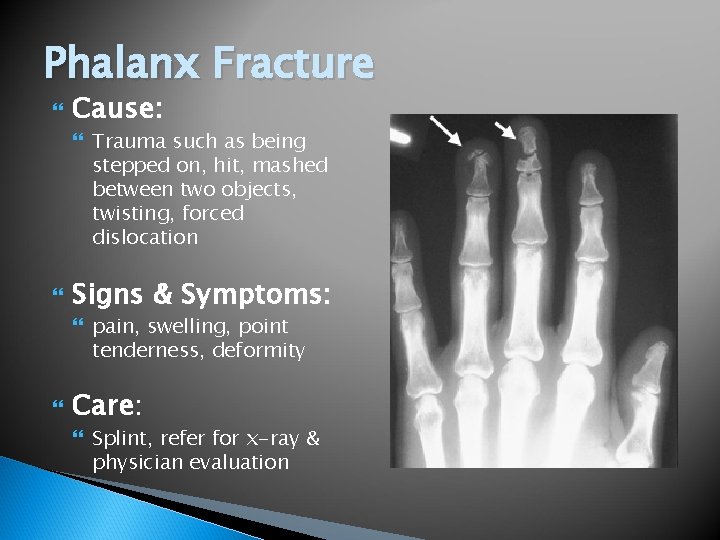 Phalanx Fracture Cause: Trauma such as being stepped on, hit, mashed between two objects,