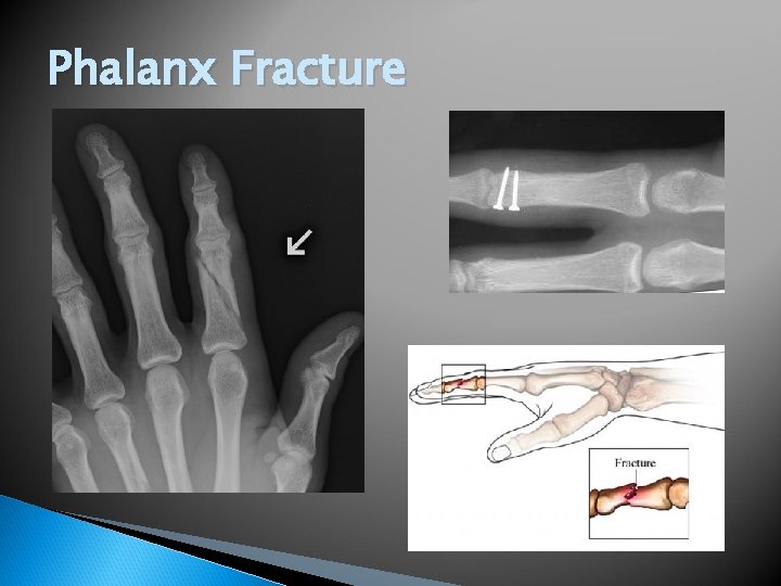 Phalanx Fracture 