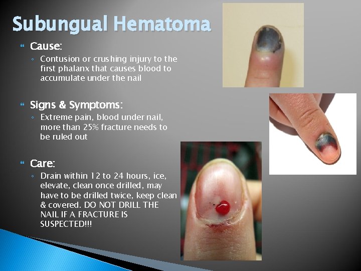 Subungual Hematoma Cause: ◦ Contusion or crushing injury to the first phalanx that causes