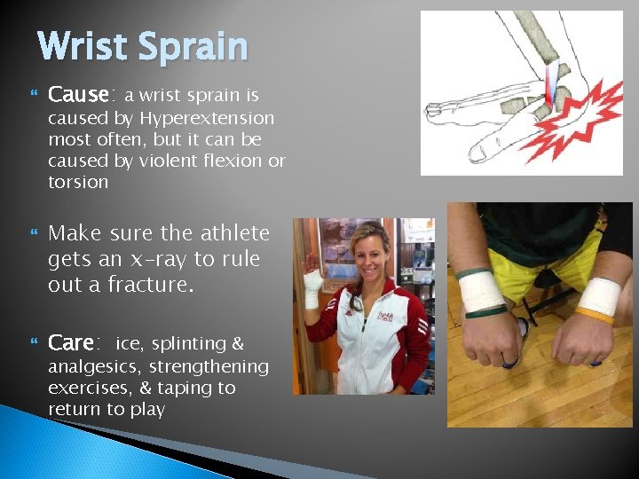 Wrist Sprain Cause: a wrist sprain is caused by Hyperextension most often, but it